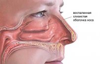 Хронический гипертрофический ринит: лечение гиперплазии слизистой носовых ходов