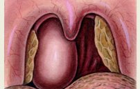 Абсцесс в горле: фото, симптомы и лечение болезни миндалин