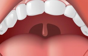 Воспаление язычка в горле: чем лечить если воспалился и опух?