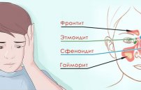 Гайморит и фронтит: симптомы и лечение