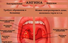 Как выглядит ангина: фото больного воспаленного горла