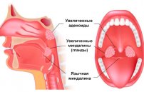 Увеличенные миндалины: лечение гланд и фото горла у взрослых