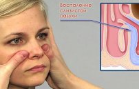 Воспаление гайморовых пазух: симптомы и лечение