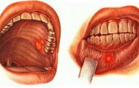 Воспаление слизистой оболочки полости рта и языка: лечение и фото