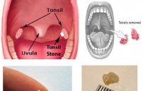 Гной в горле: фото, причины и лечение гнойного горла
