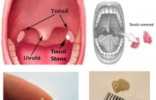 Гной в горле: фото, причины и лечение гнойного горла