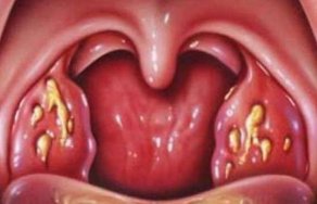 Болезни горла и гортани: фото и симптомы заболеваний