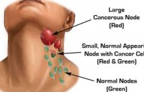 Воспаление лимфоузлов на шее: причины и лечение увеличения