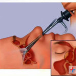 эндоскопическая операция при гайморите