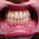 воспаление слизистой оболочки полости рта