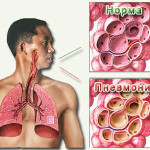 Осложнения гриппа A (H1 N1)