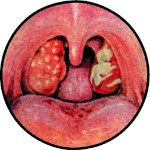 Тяжелая форма ангины симптомы thumbnail