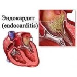 инфекционный эндокардит