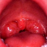 Гипертрофия язычной миндалины